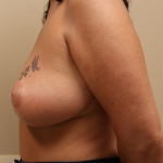 Breast Reduction Before & After Patient #617