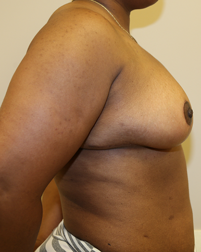 Breast Reduction Before & After Patient #638