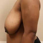 Breast Reduction Before & After Patient #649