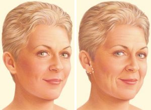 facelift-surgery-limited-incision