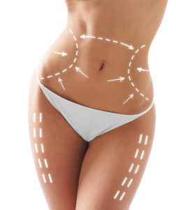 Best African American Tummy Tuck (Abdominoplasty) Orange County