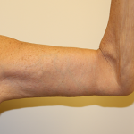 Brachioplasty (Arm Lift) Before & After Patient #767