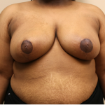 Breast Reduction Before & After Patient #1045