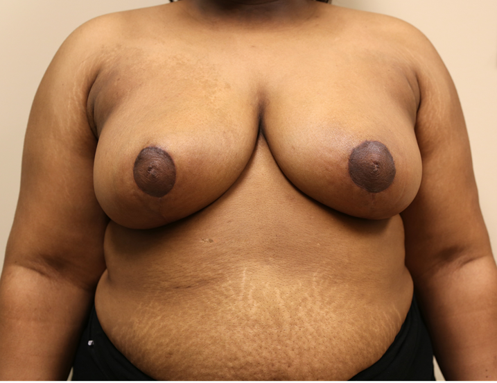Breast Reduction Before & After Patient #1045