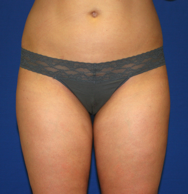 Liposuction Before & After Patient #1052