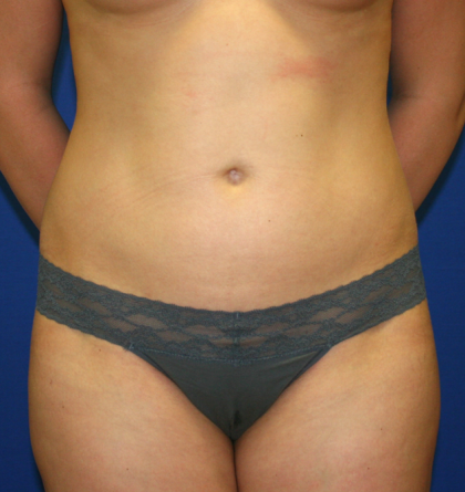 Liposuction Before & After Patient #1057