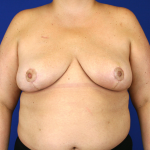 Oncoplastic Breast Reconstruction Before & After Patient #1062