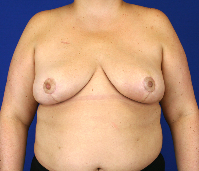Oncoplastic Breast Reconstruction Before & After Patient #1062
