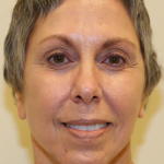 Facelift & Neck Lift Before & After Patient #694