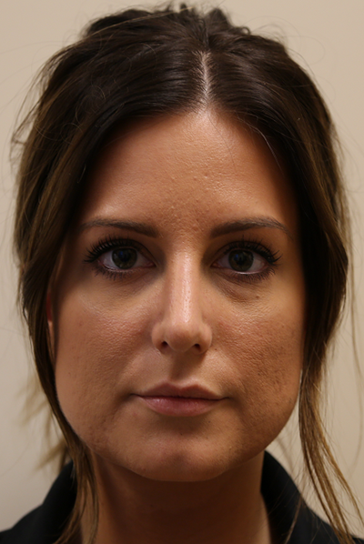 Rhinoplasty Before & After Patient #734