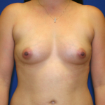 Breast Fat Transfer Before & After Patient #819
