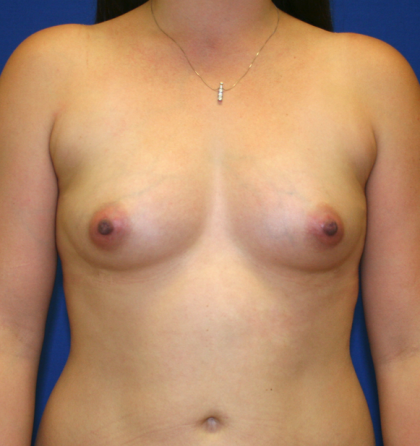 Breast Fat Transfer Before & After Patient #819