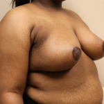 Breast Reduction Before & After Patient #1045