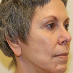 Facelift & Neck Lift Before & After Patient #694