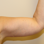 Brachioplasty (Arm Lift) Before & After Patient #701
