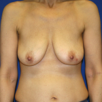 Oncoplastic Breast Reconstruction Before & After Patient #1038