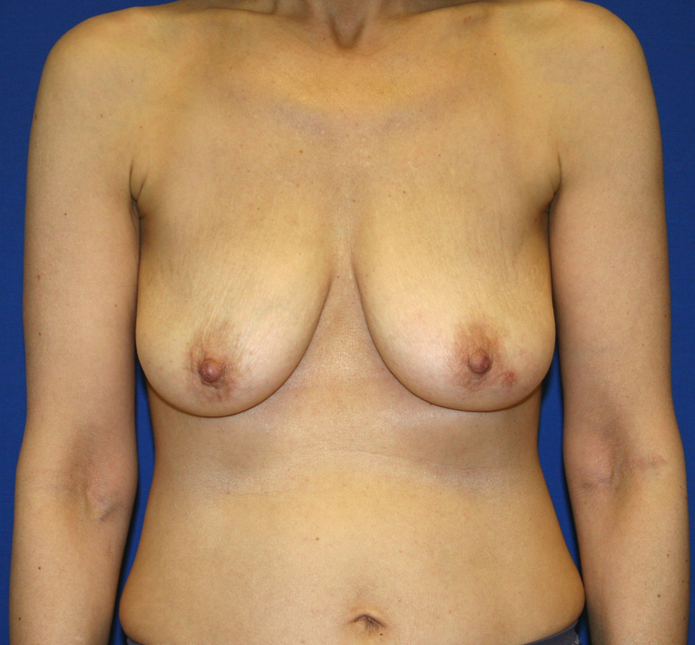 Oncoplastic Breast Reconstruction Before & After Patient #1038