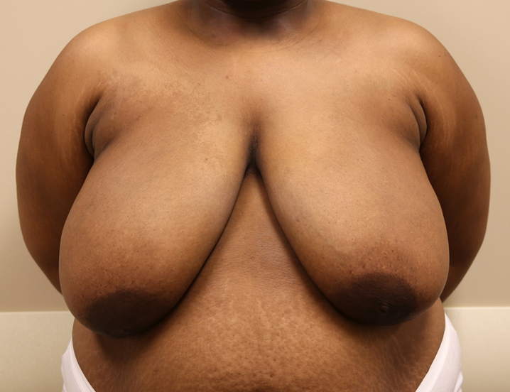 Breast Reduction Before & After Patient #1045