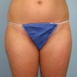 Liposuction Before & After Patient #1052