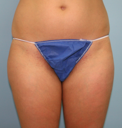 Liposuction Before & After Patient #1052