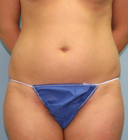 Liposuction Before & After Patient #1057