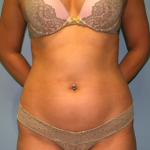 Liposuction Before & After Patient #830