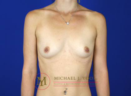 Breast Augmentation Before & After Patient #856