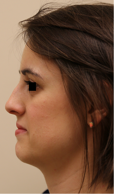 Rhinoplasty Before & After Patient #708
