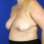 Oncoplastic Breast Reconstruction Before & After Patient #1062