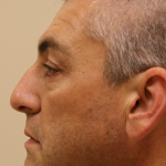 Rhinoplasty Before & After Patient #721