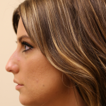 Rhinoplasty Before & After Patient #734