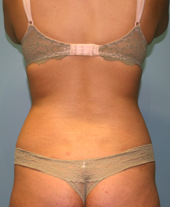 Liposuction Before & After Patient #830