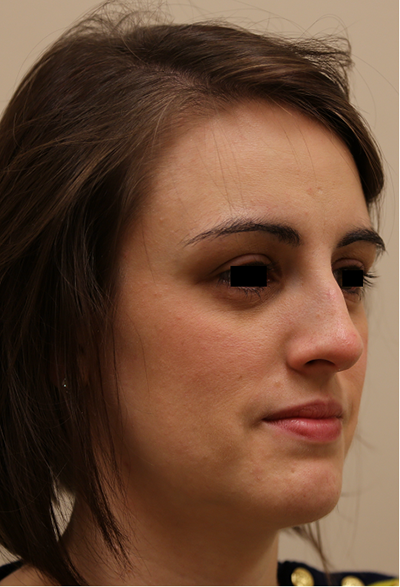Rhinoplasty Before & After Patient #708