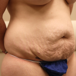 Tummy Tuck Before & After Patient #1031