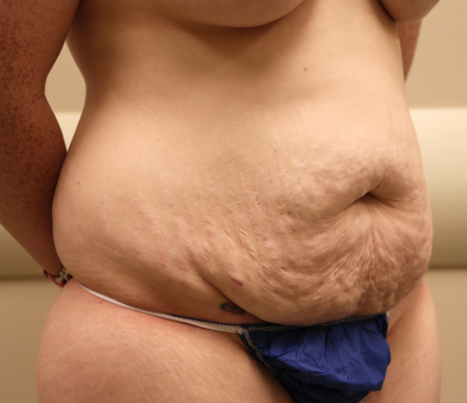 Tummy Tuck Before & After Patient #1031