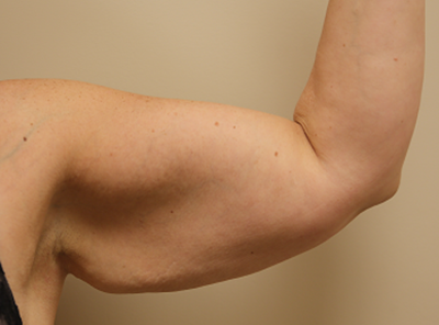 Brachioplasty (Arm Lift) Before & After Patient #701