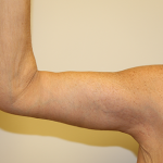 Brachioplasty (Arm Lift) Before & After Patient #767