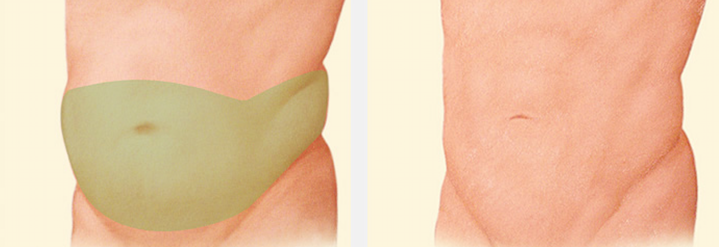 male-tummy-tuck-incision