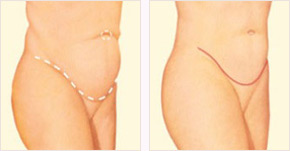 Tummy Tuck Orange County - Anaheim, Los Angeles Cosmetic Surgeon