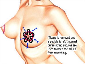 AreolaReduction2