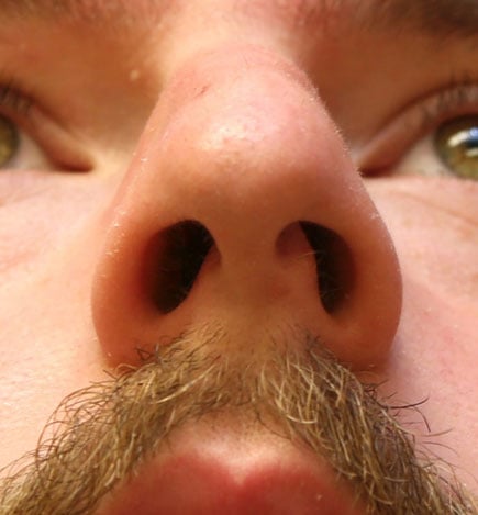 Septoplasty / Deviated Septum Repair Before & After Patient #1201