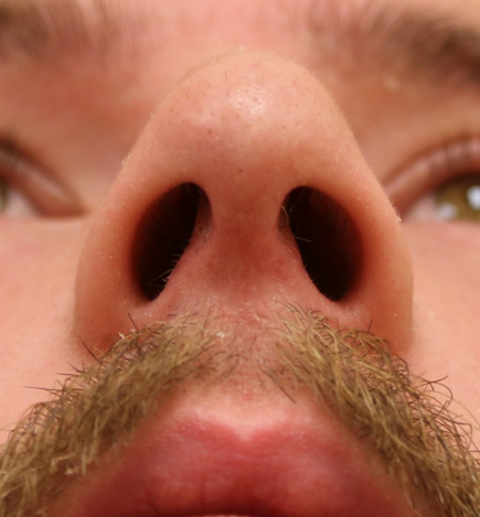 Septoplasty / Deviated Septum Repair Before & After Patient #1201