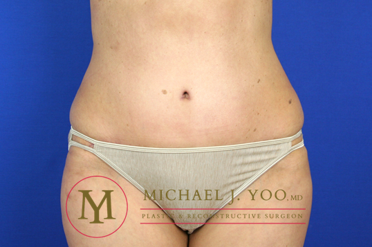 Tummy Tuck Before & After Patient #1319