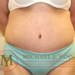 Tummy Tuck Before & After Patient #1257