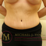 Tummy Tuck Before & After Patient #1260