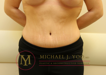 Tummy Tuck Before & After Patient #1260