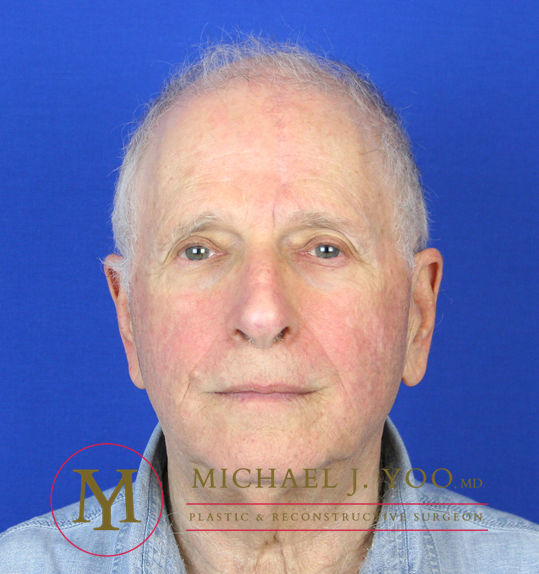 Mohs Surgery Before & After Patient #1279