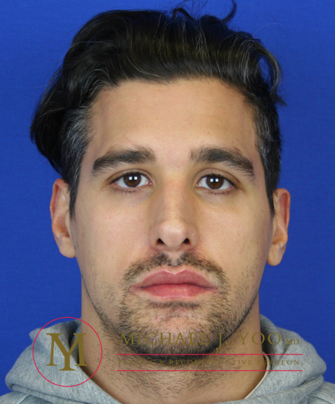 Rhinoplasty Before & After Patient #1308