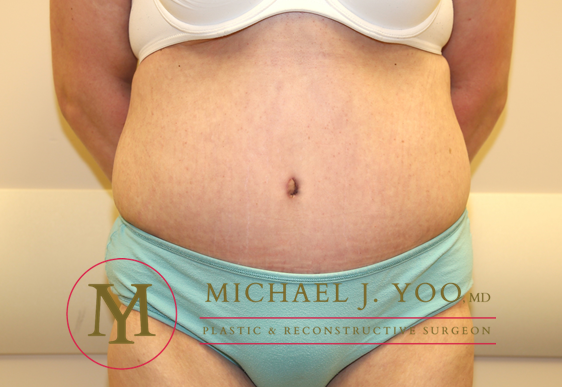 Tummy Tuck Before & After Patient #1257