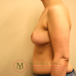 Oncoplastic Breast Reconstruction Before & After Patient #1312